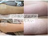 【今年の夏はノースリーブで】二の腕のざらつき改善ハーブピーリング¥25000→