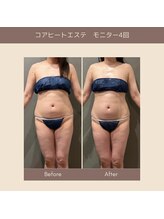 エクラ(ECLAT)/コアヒート痩身