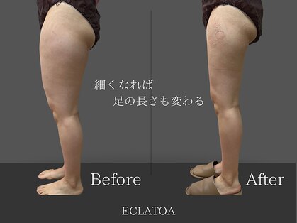 【次世代脂肪冷却・小顔ハイリフト専門店】ECLATOA　四日市/痩身/ダイエットの写真