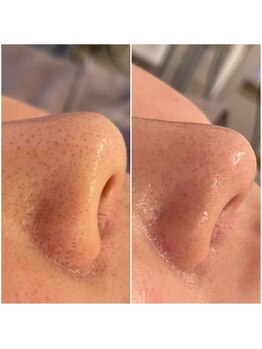 ミュレア 新宿本店(mulea)/【ハイドラフェイシャル】