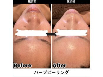 ビエストラ(Biestora)/剥離なしハーブ