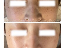 ルウス(Ruusu)/しみケアもお任せください