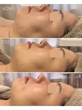 エービューティーサロン 松山店(A BEAUTY SALON.)/30代女性　二重アゴケア