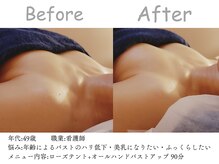 シエル(Siele)/デコルテのそげ・ボリューム不足