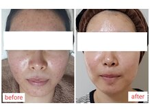 ミュー(Mieux)/長年の悩みの跡がなくなっていく