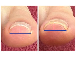 巻き爪ケア（UPジェル）