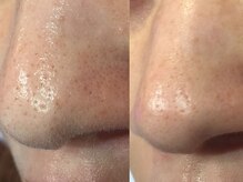 シロ(CHILO)/ハイドラ　before　after４