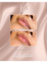 エスペランサ(Esperanza)/リップピンクメラニンケア