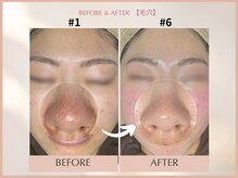 シンスプラス(SINCE+)/毛穴集中改善コース