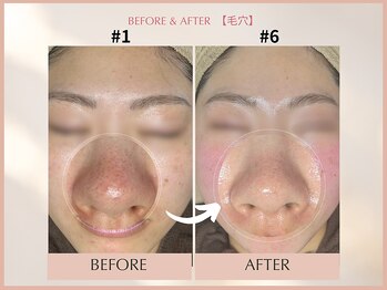 シンスプラス(SINCE+)/毛穴集中改善コース