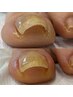 巻き爪による痛みや違和感を、専用ジェルでやさしく補正。1本