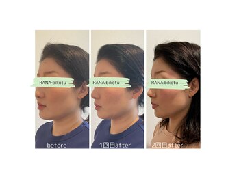 ラーナビコツ(RANA-bikotsu)/【整顔】小顔矯正