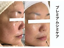 プレジール(plaisir)/シミケアコース