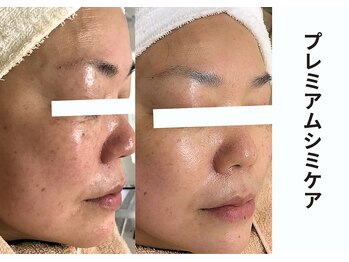 プレジール(plaisir)/シミケアコース