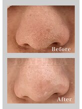 ダリア(DAHLIA)/毛穴洗浄／ハイドラスプラッシュ