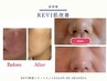 【ニキビケア・肌荒れ◎】ハーブピーリング（顔首）ヘッドスパ付き☆50分
