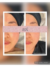 ソイ(soi)/美肌光フェイシャル