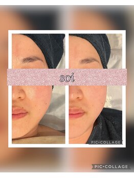 ソイ(soi)/美肌光フェイシャル