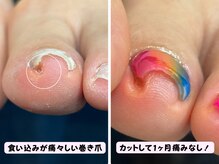 ココネイル(coco.nail)/Foot巻き爪痛み軽減ケア