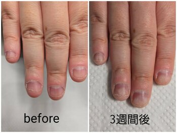 プリンセスネイル(Princess nail)/深爪矯正3週間