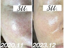 スウ(su:)/ルヴィのハーブピーリングで肌育