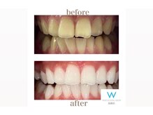 ホワイトニングショップ 島根店/Before&After美白ホワイトニング