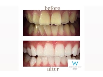ホワイトニングショップ 島根店/Before&After美白ホワイトニング