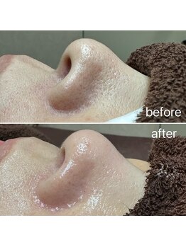 エクラ バイ シャンリィ(eclat by shanLy)/レチノール効果!