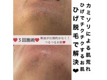 ファミーユ(famille)の雰囲気（高出力脱毛でVIOの黒ずみも改善！高出力で濃い毛も産毛にも◎）