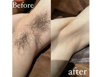 ワンエイト(One Eight)/【ビフォーアフター】脇