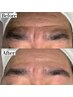 【男性ワックス脱毛】額&眉毛周り 3,500円