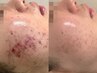 《毛穴ニキビ卒業ケア》肌解析+オ-ダ-メイド施術+乳酸ピーリング+美容液導入