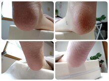 あし処 トコトコ(tocotoco)の雰囲気（【角質ケア】ツルスベ足に◎↑ビフォー↓アフター）