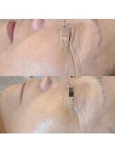 リンド(Lindo)/ACトリートメント　