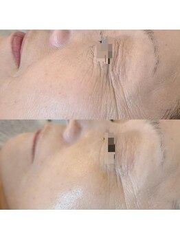 リンド(Lindo)/ACトリートメント　