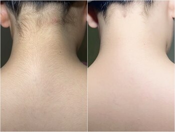 ソヤ クリエイティブヘアー(SOYA creative hair)/襟足・背中シェービング