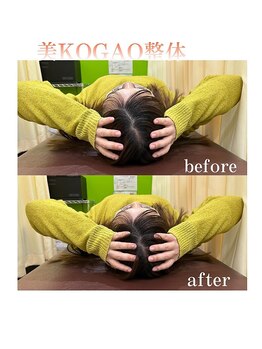 わだち鍼灸整骨院 吹田岸辺院/美小顔矯正ビフォーアフター