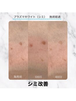 エクラ 六本木(eclat)/プラズマホワイト