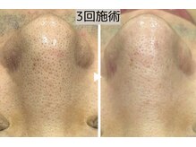 ロワ(Roi)/【毛穴洗浄+引き締め】3回施術