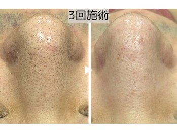 ロワ(Roi)/【毛穴洗浄+引き締め】3回施術