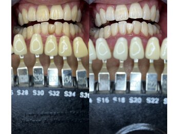 トウキョースワーズ 渋谷店(TOKYO SWRS)/#ホワイトニング #渋谷 #池袋
