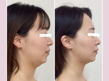＼効果に自信あり／Qttoの小顔矯正で劇的改善Before→After【たるみ改善/サイズ/歪みetc...】