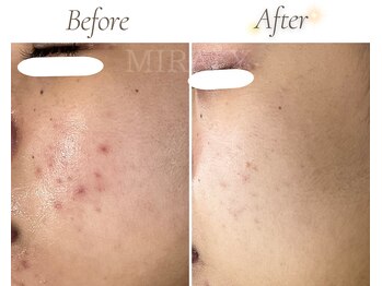 ミラリー(MIRALY)/頬ニキビケア 4ヶ月(20代前半)