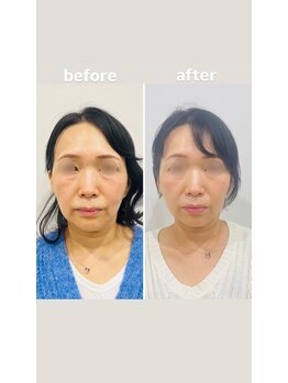 赤沼鍼灸整骨院/美・健康・笑顔に導く美容鍼