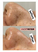 シロ(SHIRO)/黒ずみ毛穴改善