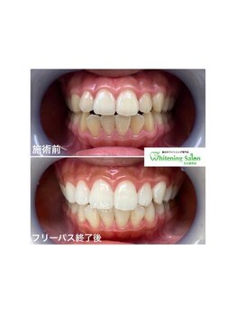 ホワイトニングサロン 名古屋駅店/【ホワイトニング施術例】