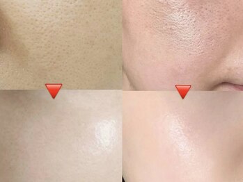 ビューティーサロン リリー(Lily)の写真/憧れの水光肌へ導くプレミアム美白施術。１回の施術で効果実感。