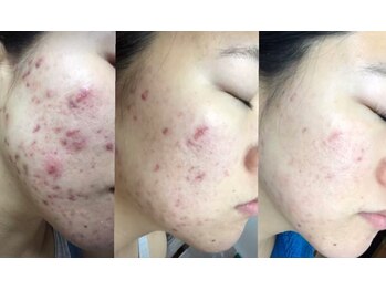 パールプラス 行橋店/脱毛＋フェイシャルで肌質改善！