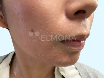 グリーンピール エルモナ(GREENPEEL ELMONA)/【グリーンピール5Days】シェド