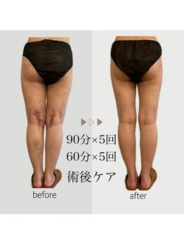 ファミーユ 名古屋店/【術後ケア】足吸引後ケア